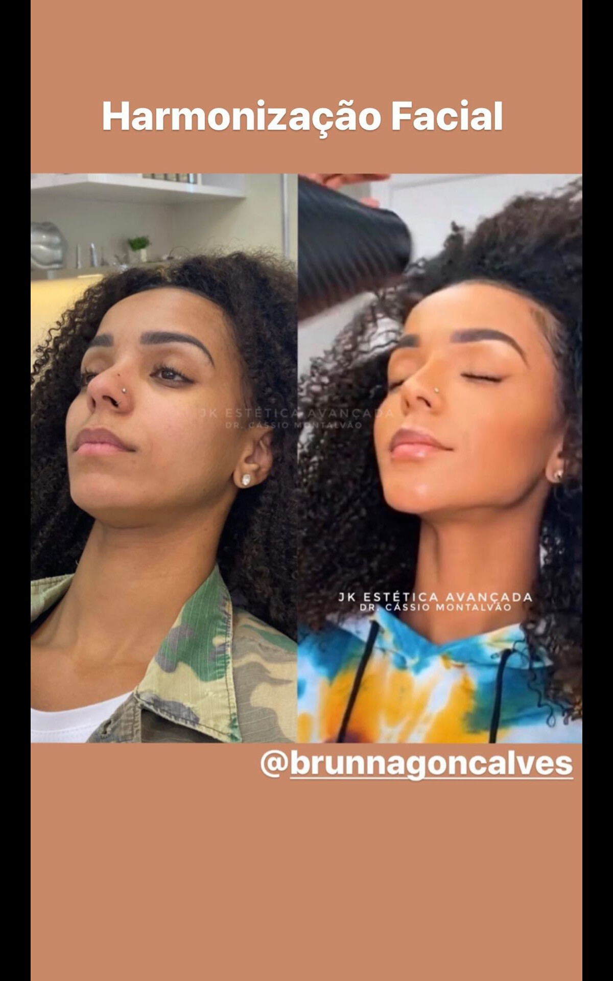 Foto Mulher De Ludmilla Brunna Gon Alves Faz Harmoniza O Facial