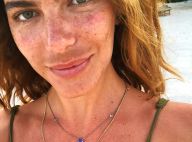 Mariana Goldfarb explica mancha no rosto após postar foto sem make: 'Melasma'