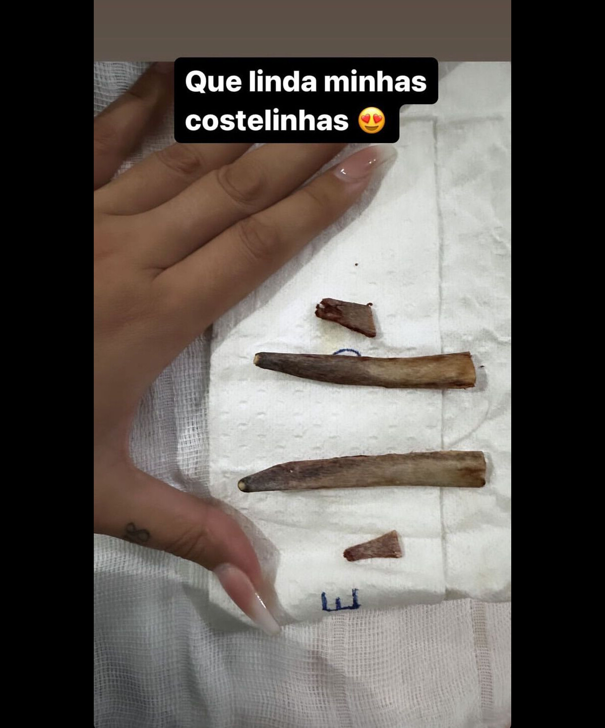 Foto Andressa Urach retirou as costelas fez lipoaspiração e colocou