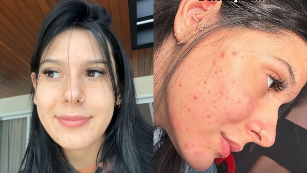 Foto Ana Castela Mostra Antes E Depois De Tratamento Para A Acne E