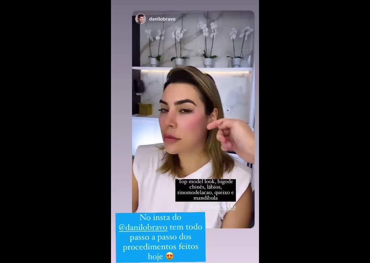 V Deo Naiara Azevedo Mostra Harmoniza O Facial Veja Antes E Depois