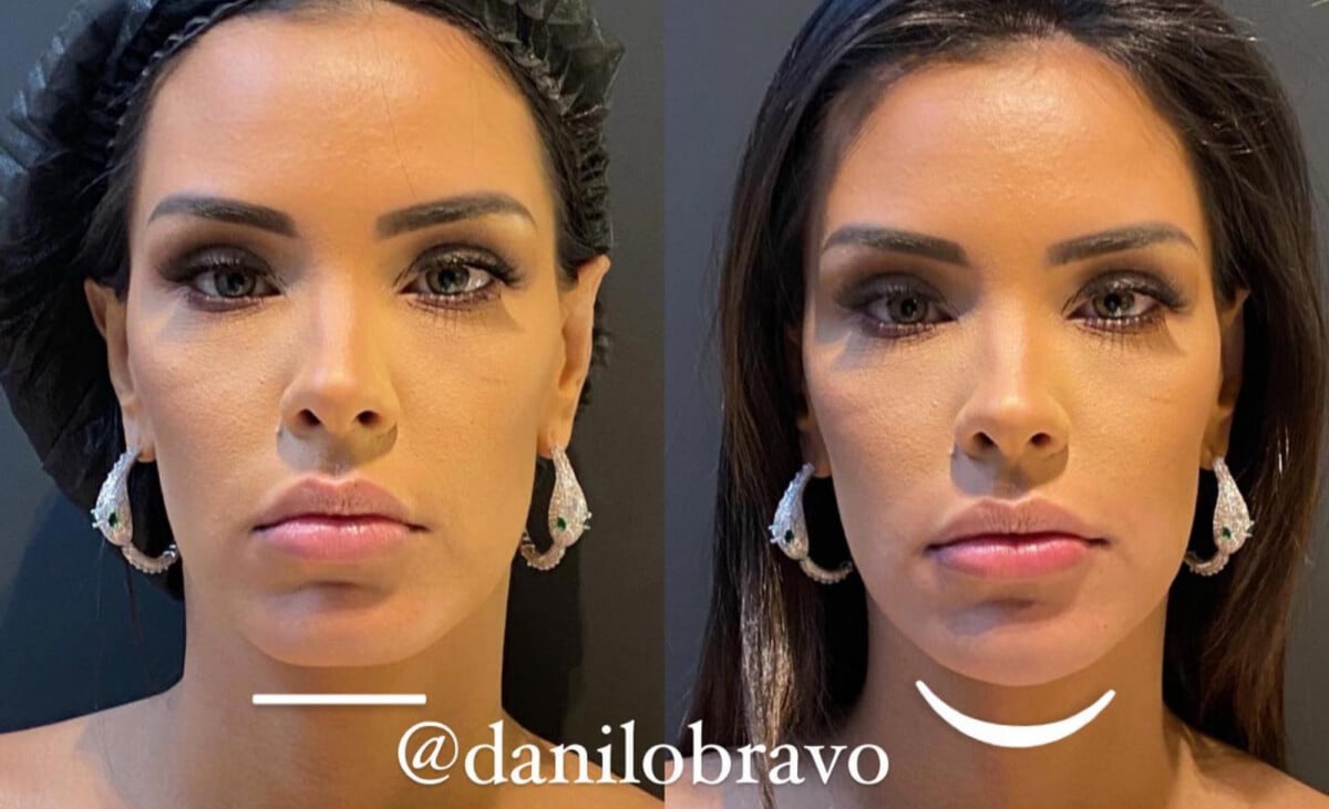 Foto Ivy antes e depois da harmonização facial Purepeople