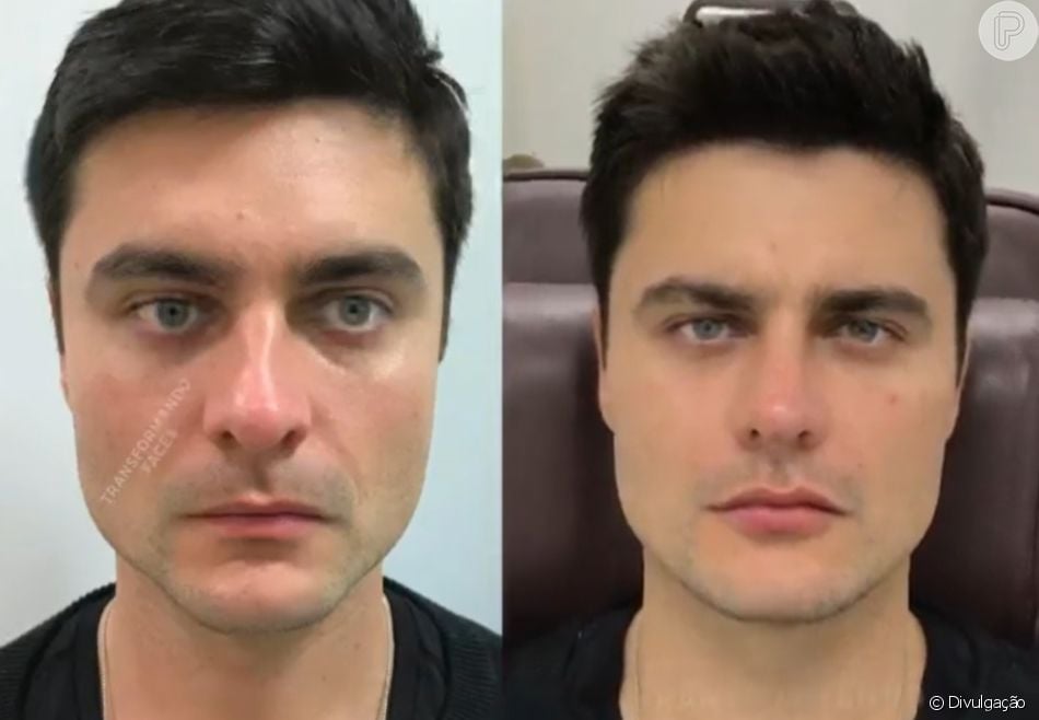 Fotos de famosos que fizeram harmonização facial antes e depois