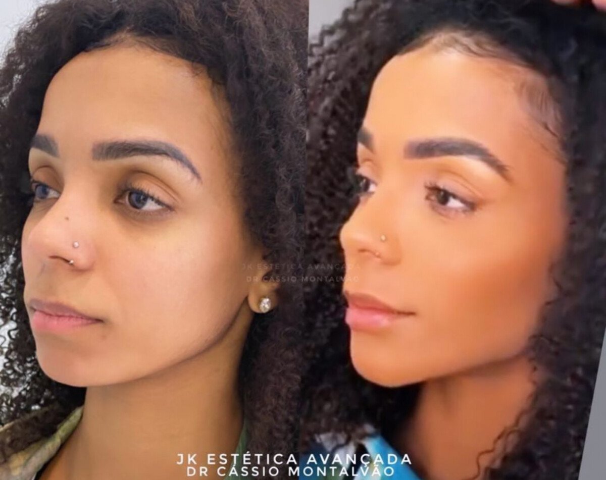 Foto Brunna Gon Alves Antes E Depois Da Harmoniza O Facial Purepeople