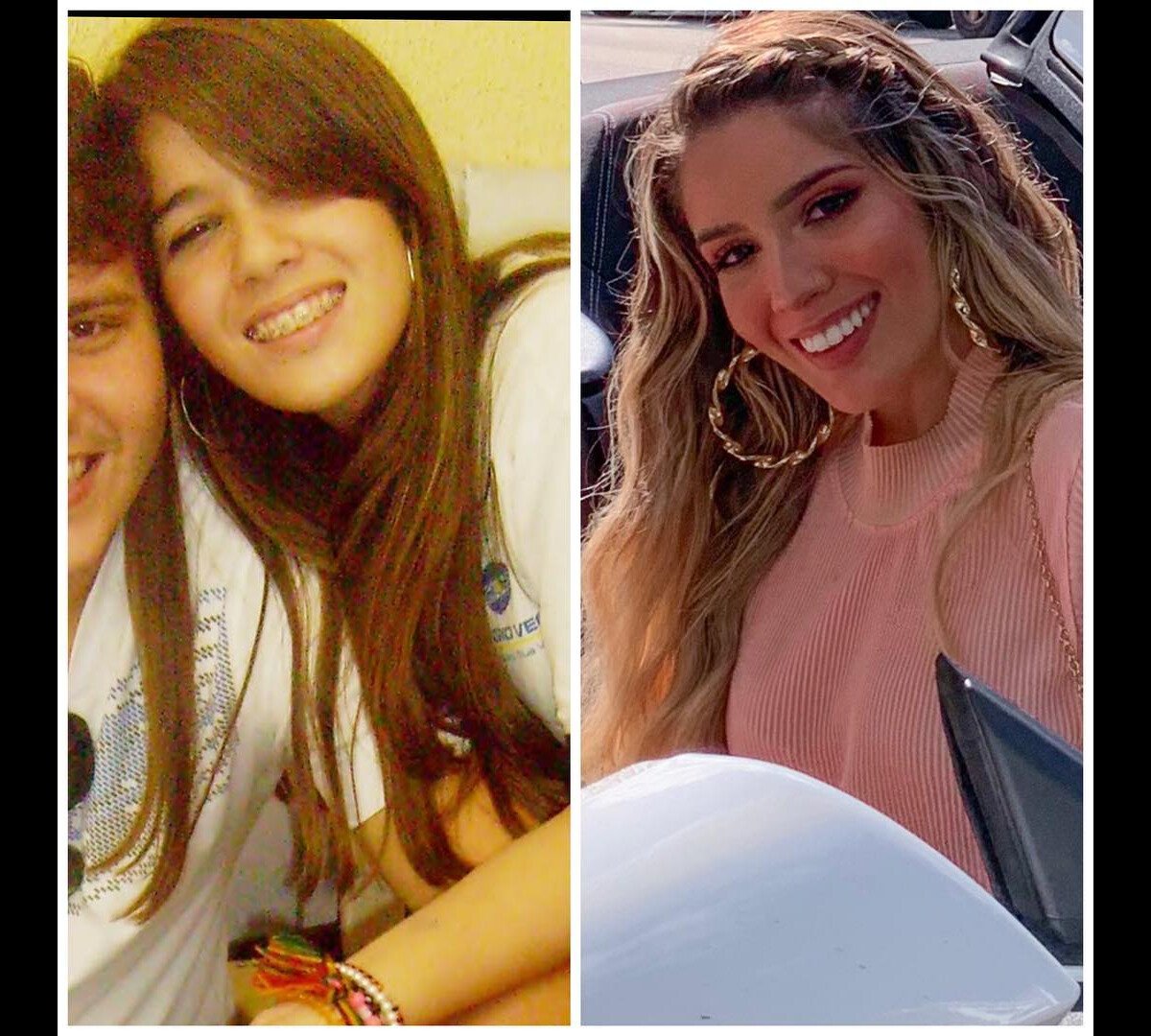 Foto Antes E Depois De Karoline Lima H Alguns Anos A Modelo J