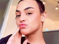 Pabllo Vittar fica com olho roxo após ensaio de clipe: 'Dei joelhada na cara'