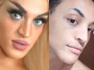 Pabllo Vittar mostra nariz após tirar curativos de cirurgia: 'Ficou bafo'
