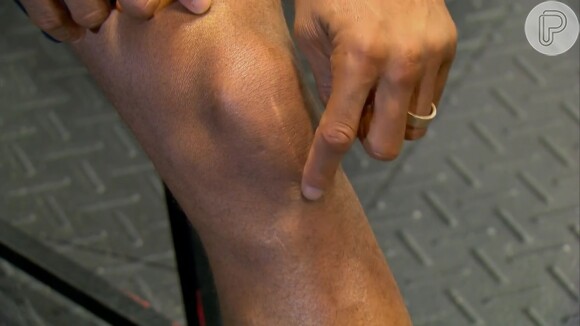 Anderson Silva mostrou a pequena cicatriz que ficou após a cirurgia