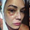 No último domingo, 3 de julho de 2016, Luiza Brunet divulgou ao fantástico uma foto em que aparece com o olho machucado