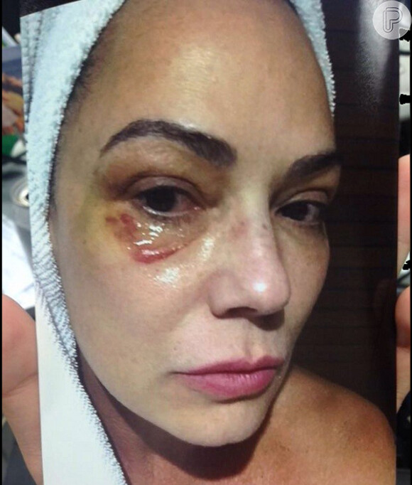No último domingo, 3 de julho de 2016, Luiza Brunet divulgou ao fantástico uma foto em que aparece com o olho machucado