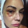 
Luiza Brunet exibiu olho roxo na TV após agressão

