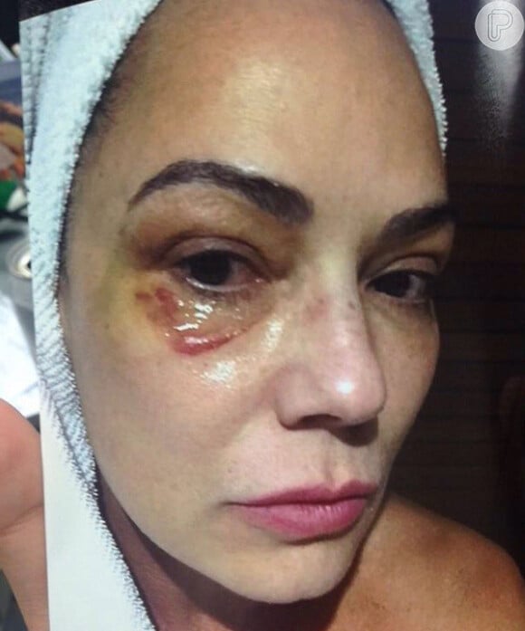 
Luiza Brunet exibiu olho roxo na TV após agressão

