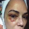 Luiza Brunet mostrou no 'Fantástico' uma foto de como ficou após ser agredida por Lírio Parisotto