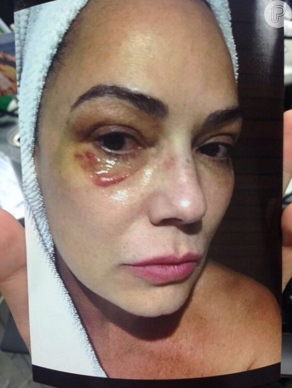 Luiza Brunet mostrou no 'Fantástico' uma foto de como ficou após ser agredida por Lírio Parisotto