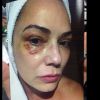 Luiza Brunet acusa Lírio Parisotto de ter lhe quebrado quatro costelas e de um soco, que deixou o seu rosto roxo