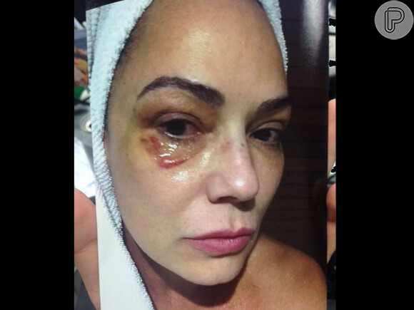 Luiza Brunet acusa Lírio Parisotto de ter lhe quebrado quatro costelas e de um soco, que deixou o seu rosto roxo