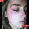 A ex-mulher de Johnny Depp, Amber Heard, mostrou o rosto machucado ao site TMZ