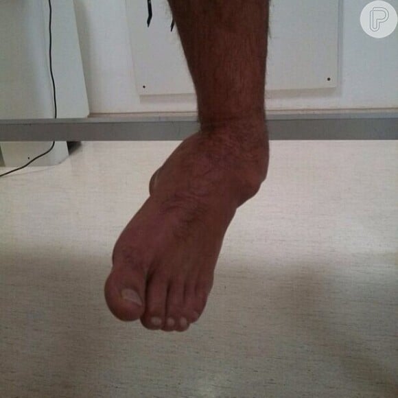 Kiko Pissolato mostrou a foto de seu pé após sofrer a luxação. 'Cirurgia, pinos e muletas por uns meses! Que eu aproveite meu tempo pra pensar, ler, escrever... É a vida!', escreveu o ator em seu Instagram