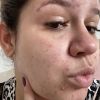 Marília Mendonça surpreende ao mostrar rosto cheios de espinhas após gravidez do filho, Léo