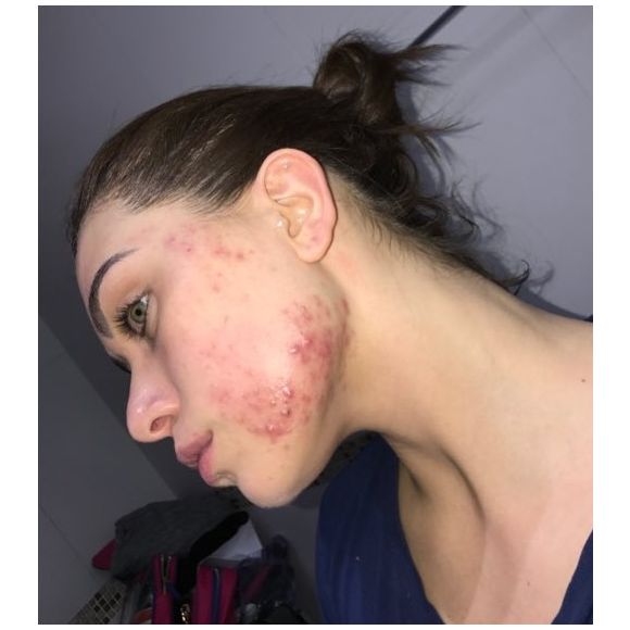 Flavia Pavanelli exibe rosto com espinhas