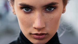 Acne adulta: dermato conta quais os cuidados para lidar com as espinhas!