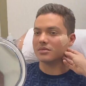 Wesley Safadão mostrou o resultado de sua harmonização facial