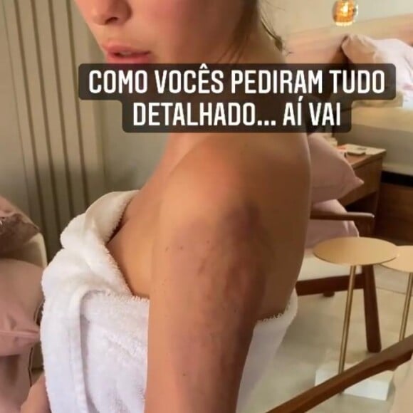 Bárbara Evans explica braços doloridos: 'Tive que aplicar a injeção para não ter trombose'