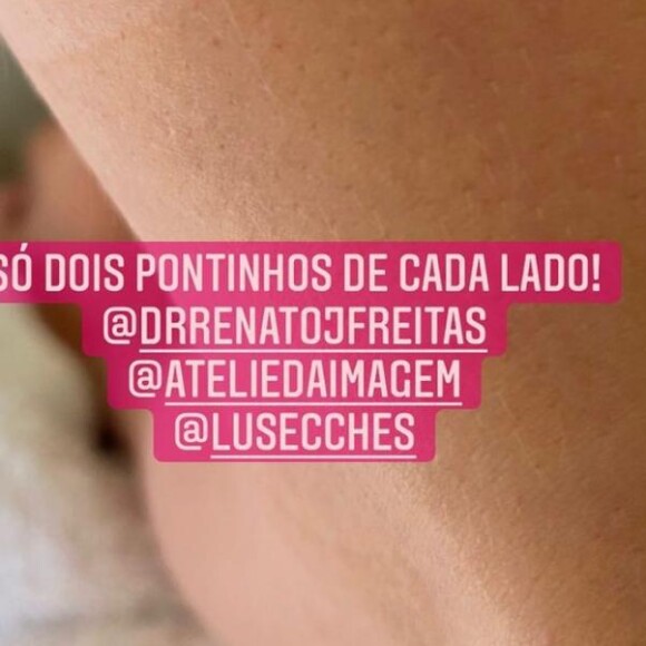 Bárbara Evans mostra pontos de cirurgia nos braços