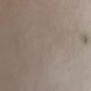 Thaeme mostra barriga com marcas roxas das injeções