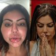 Após 'A Fazenda 13', Liziane Gutierrez detalha cirurgia de retirada de produto de harmonização facial: 'Fiquei com um nódulo no rosto, não sei se vai sair'