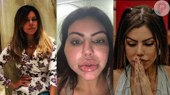Após 'A Fazenda 13', Liziane Gutierrez detalha cirurgia de retirada de produto de harmonização facial: 'Fiquei com um nódulo no rosto, não sei se vai sair'
