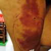 Andressa Urach teve uma infecção na perna por causa do hidrogel