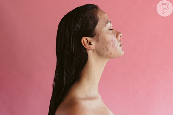 Quem tem espinhas na pele precisa manter o skincare em dia: hidratar a pele e fazer a limpeza pode ajudar a reduzir as inflamações.