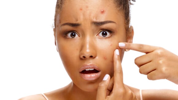Mitos e verdades sobre a pele acneica: o que é fato e o que é fake no skincare de quem tem espinhas?