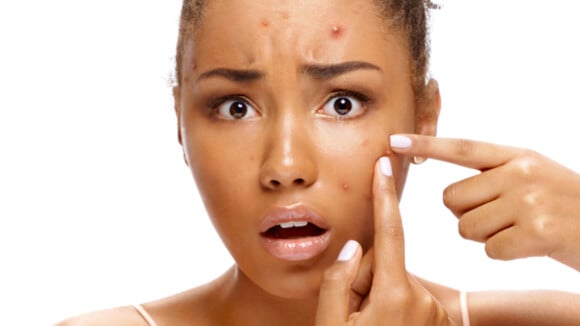 Mitos e verdades sobre a pele acneica: o que é fato ou fake no skincare de quem tem espinhas?