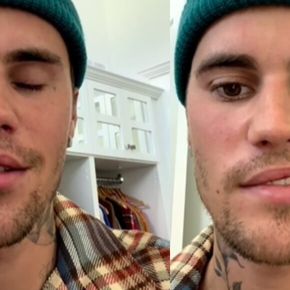 Justin Bieber mostra sequela de doença na web