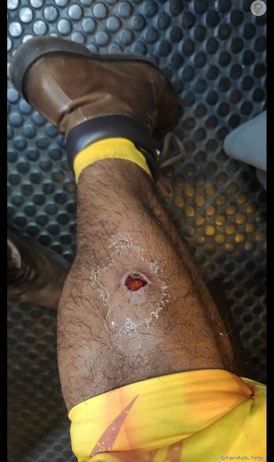 No Limite: Lucas mostra picada de aranha aos seguidores