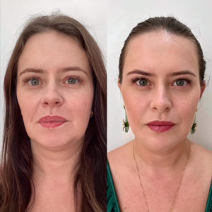 Mari Bridi antes e depois da harmonização facial