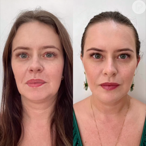 Mari Bridi antes e depois da harmonização facial