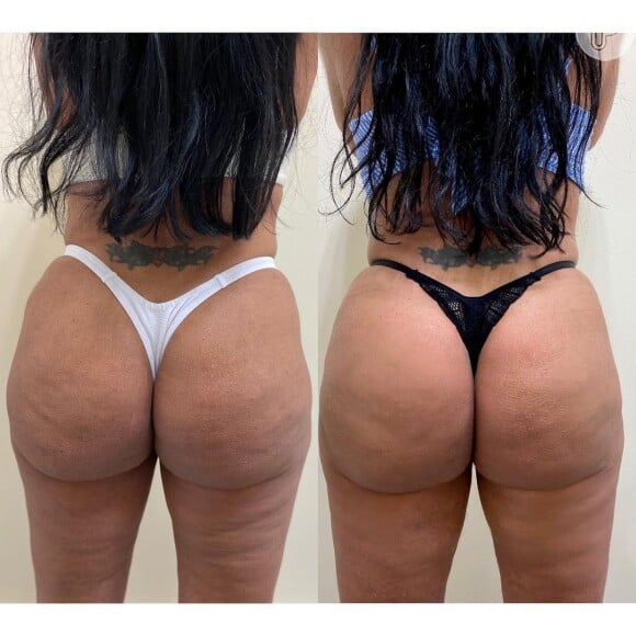 Bumbum de Gretchen: veja antes e depois