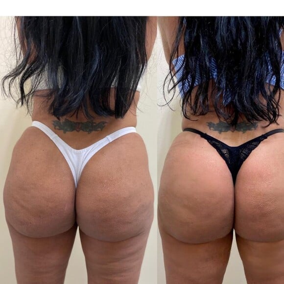 Bumbum de Gretchen: veja antes e depois