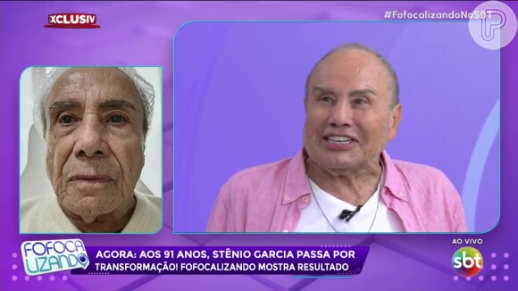 Após harmonização facial, Stenio Garcia aparece com o rosto inchado por conta de corticoides e web comenta resultado do procedimento estético