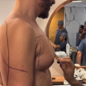 Eliezer além de fazer a cirurgia de ginecomastia também aproveitou para fazer uma lipoaspiração