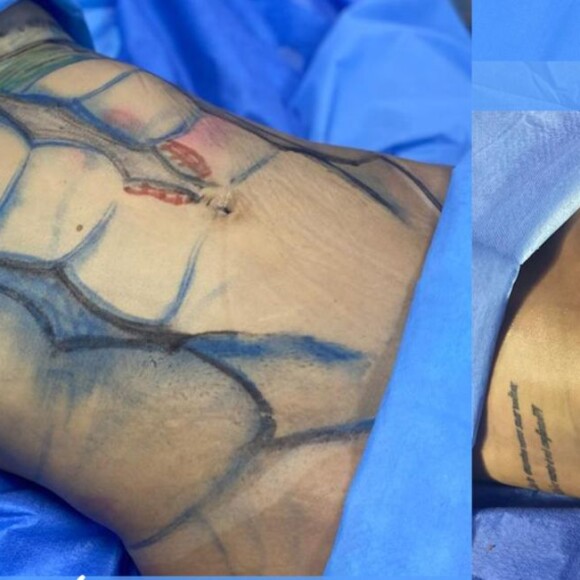 Deolane Bezerra antes e depois da lipo LAD 
