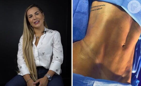 Deolane Bezerra fez lipo LAD que utiliza as tecnologia Vaser, que liquefaz a gordura e fibroses, e Renuvion, que trata a flacidez ao aumentar a retração da pele