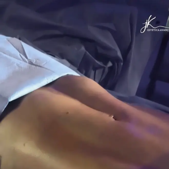 Deolane Bezerra e a lipo LAD: as tecnologias citadas acima são aplicadas ainda no centro cirúrgico, imediatamente após a lipoaspiração