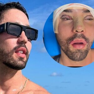 Rico Melquiades passa por procedimentos estéticos após xingamentos na web