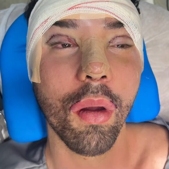 Rico Melquiades fez cirurgia na boca, palpebras, nariz e testa