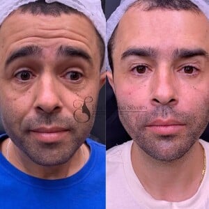 Antes e depois de Diones Silva após harmonização facial