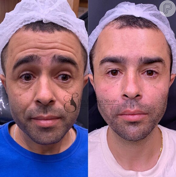 Antes e depois de Diones Silva após harmonização facial